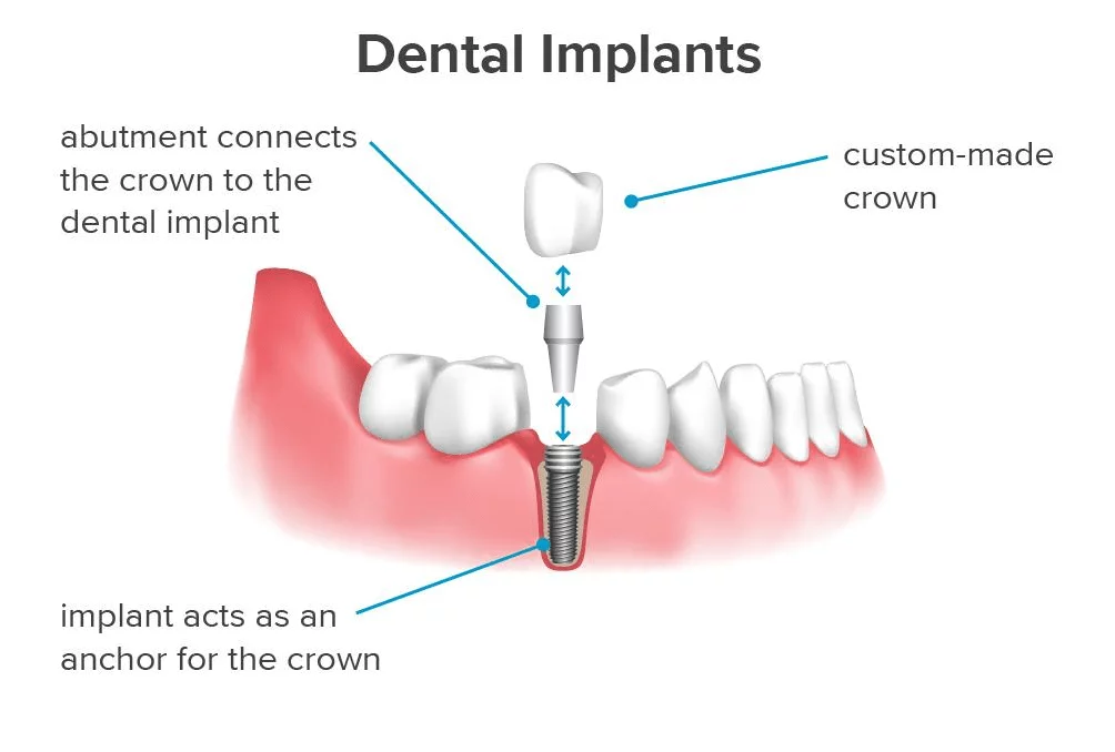 dental implant center with payment plans