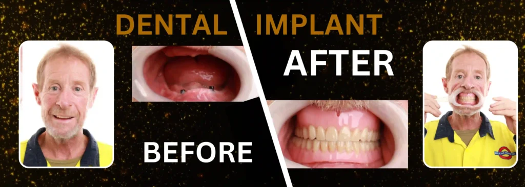 Dental Implant