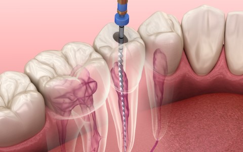 Endodontic root canal treatment process. Medically accurate toot