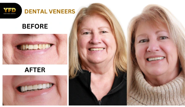 Before and after dental veneers treatment