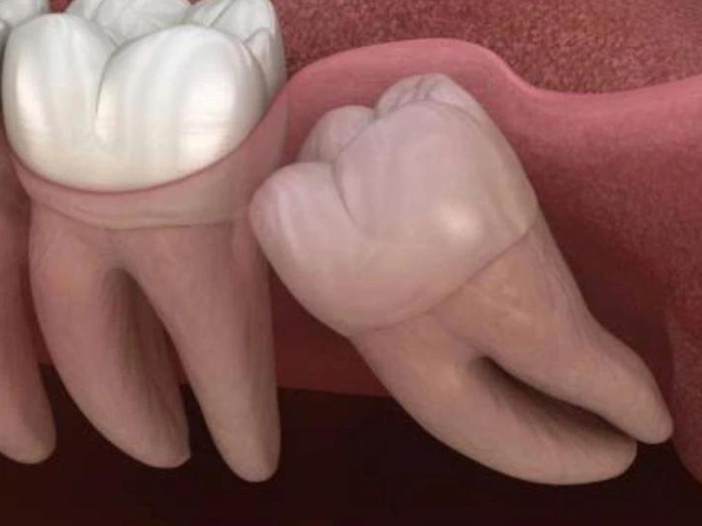 know wisdom tooth issues and safe wisdom tooth removal procedure
