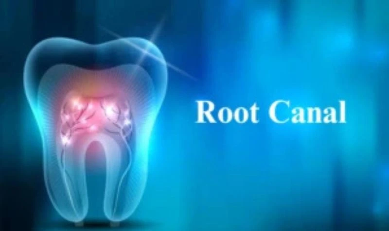 Root canal