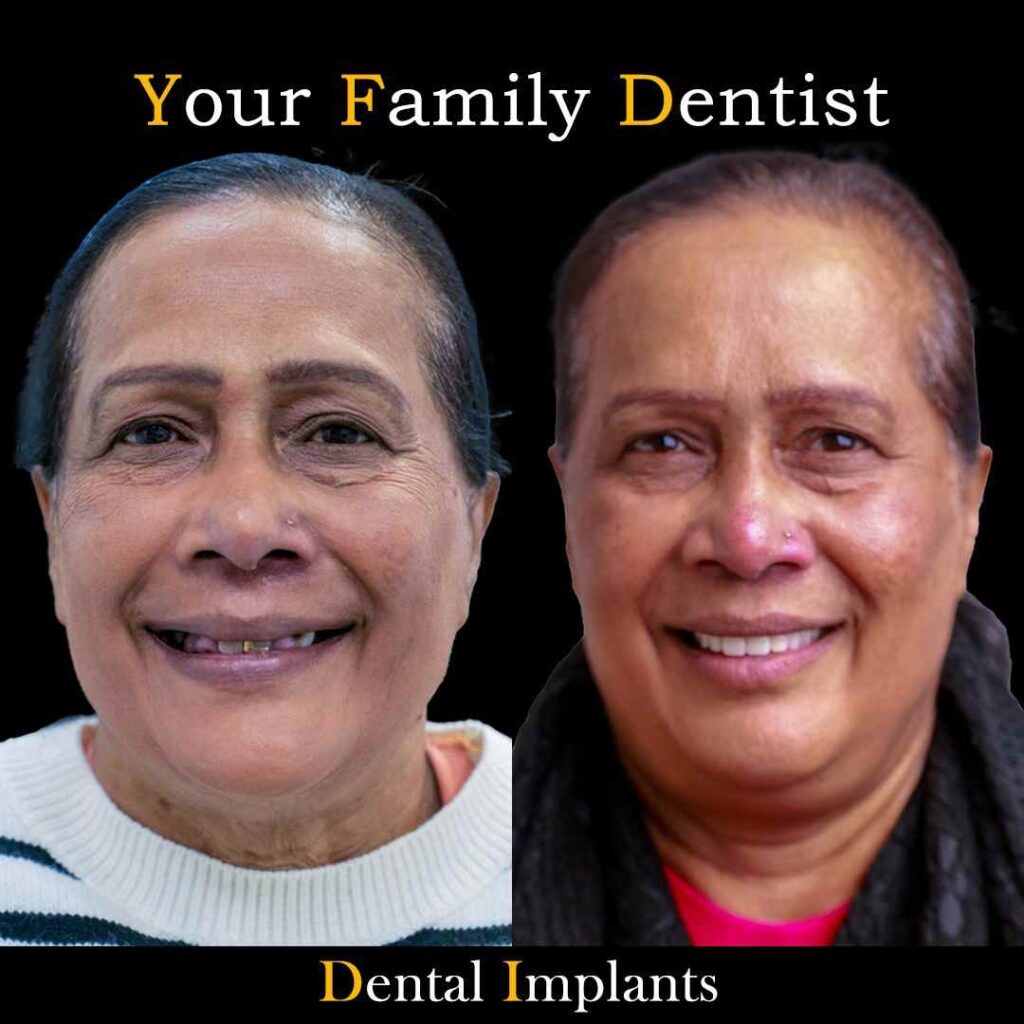 Abida lock implant