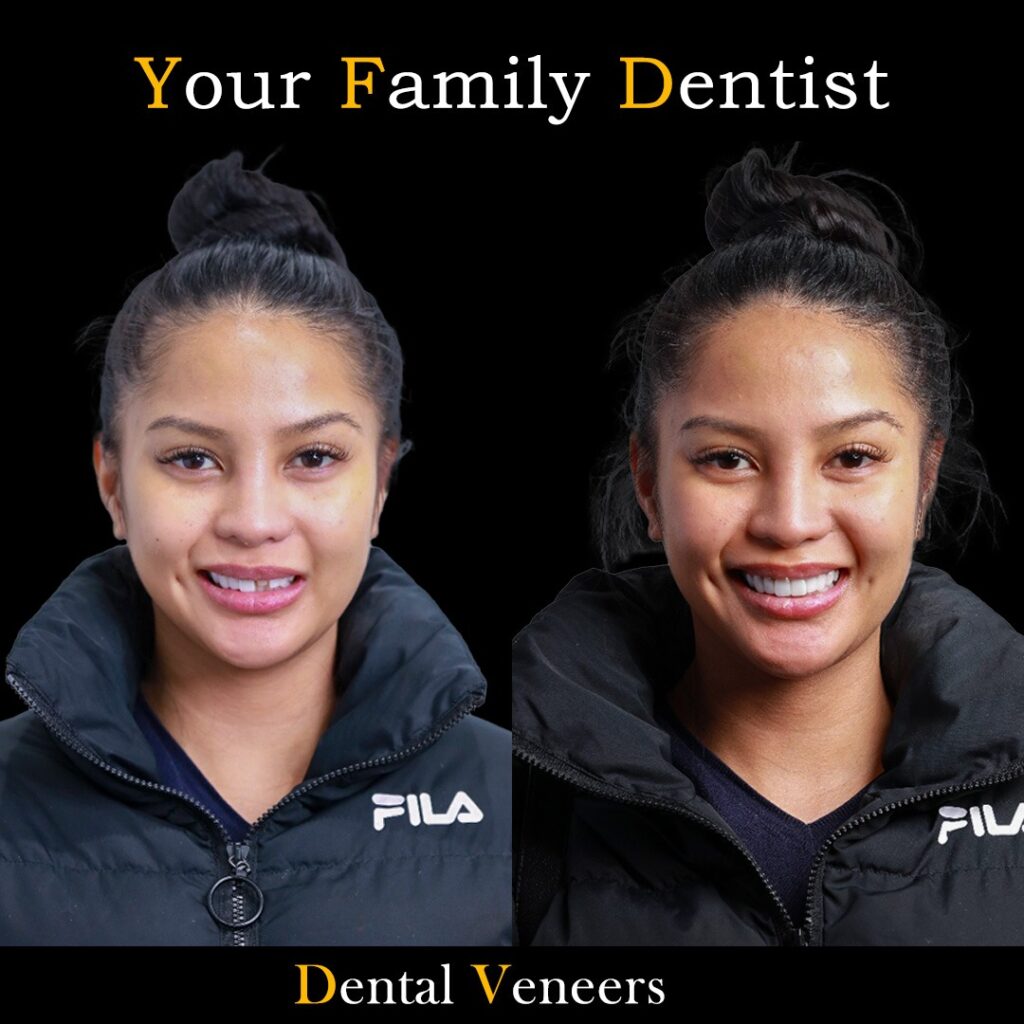 Dental Veneers