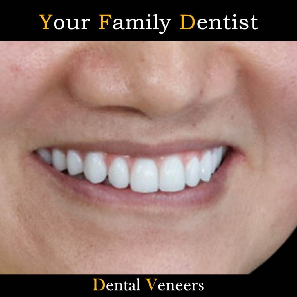 Dental Veneers
