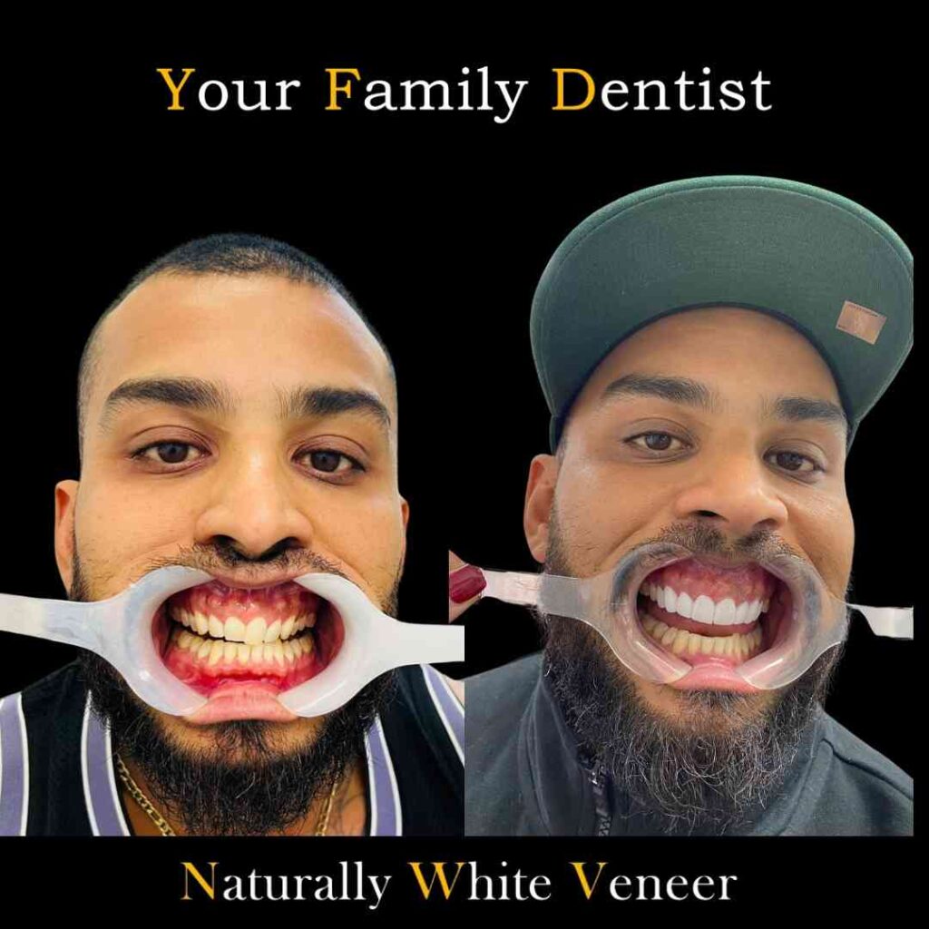 Natural white veneers
