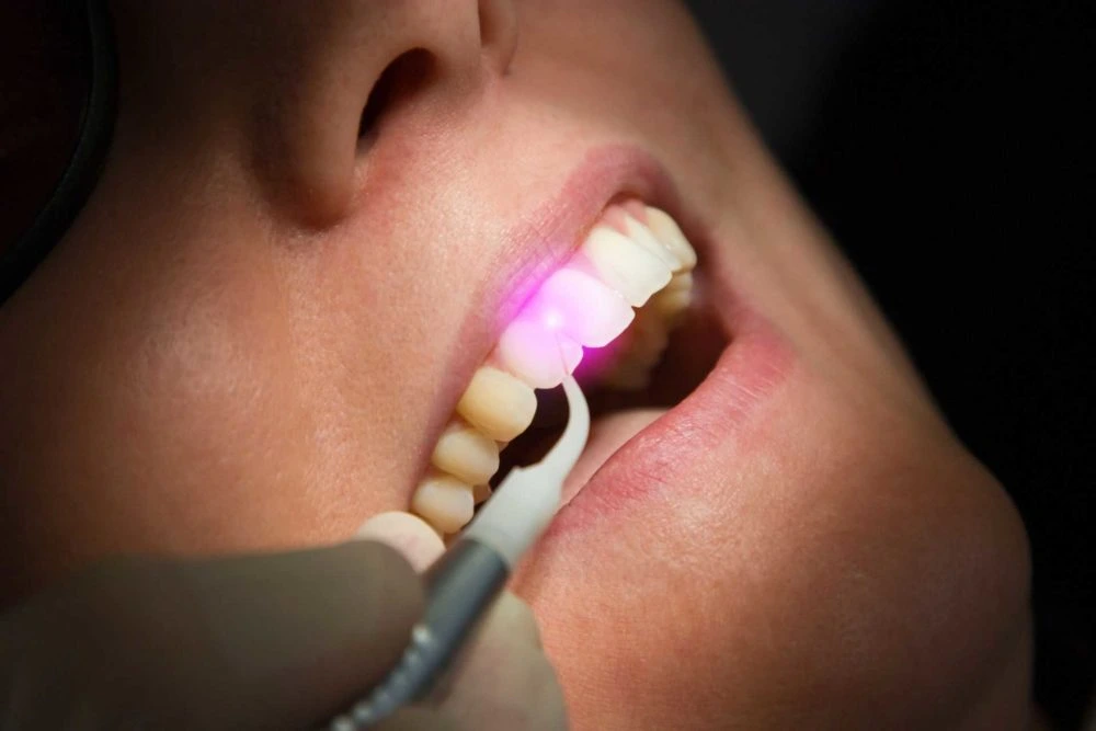 Laser dental technologys helps to replace the traditional dental drill to reduce patient anxiety