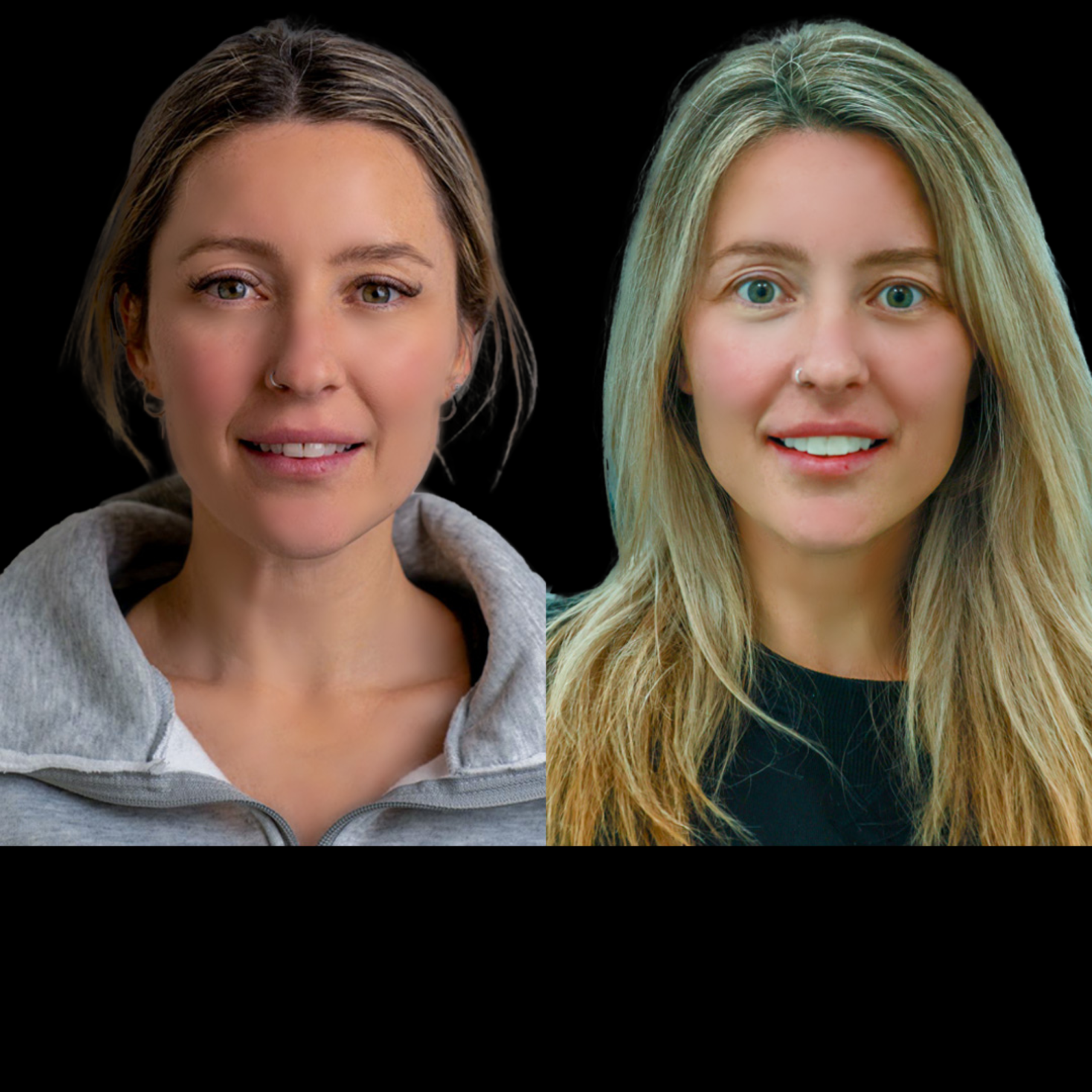 Dental Veneers Transformation