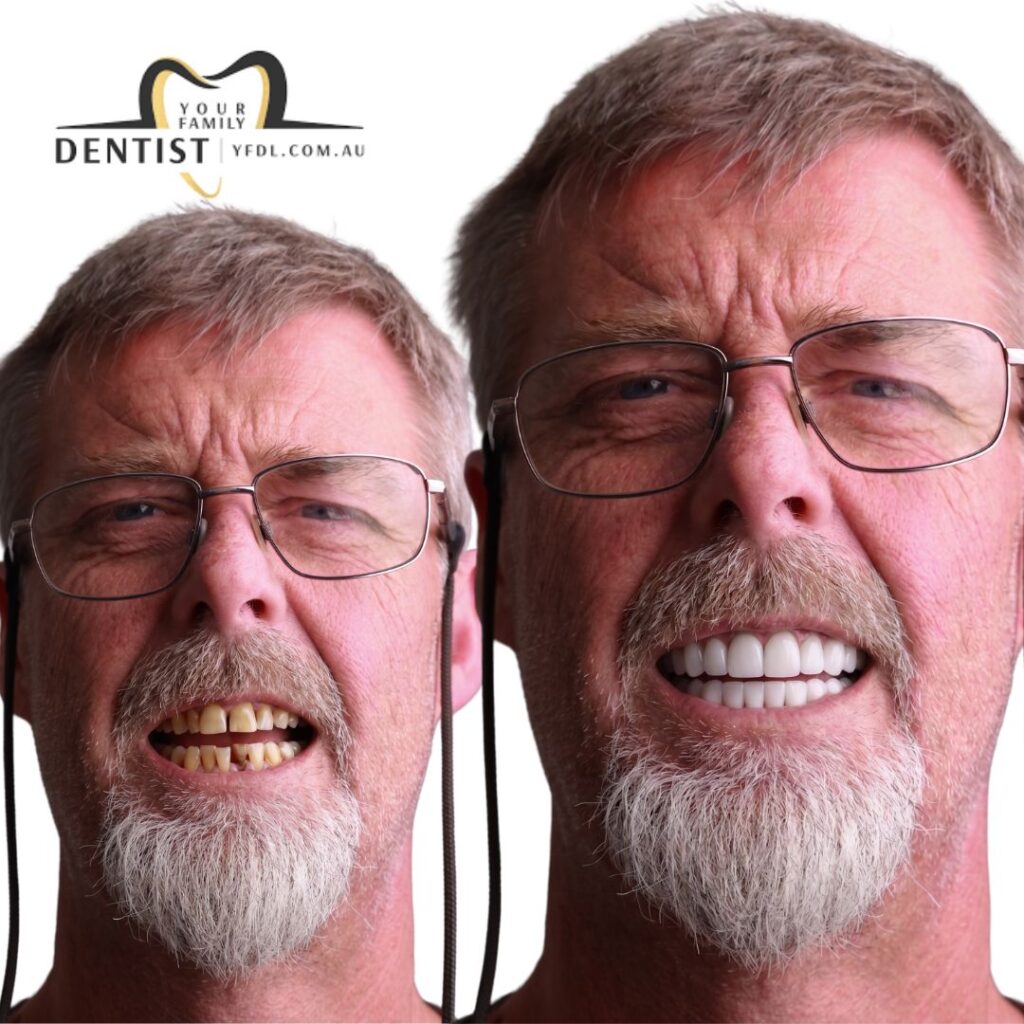Dental veneers