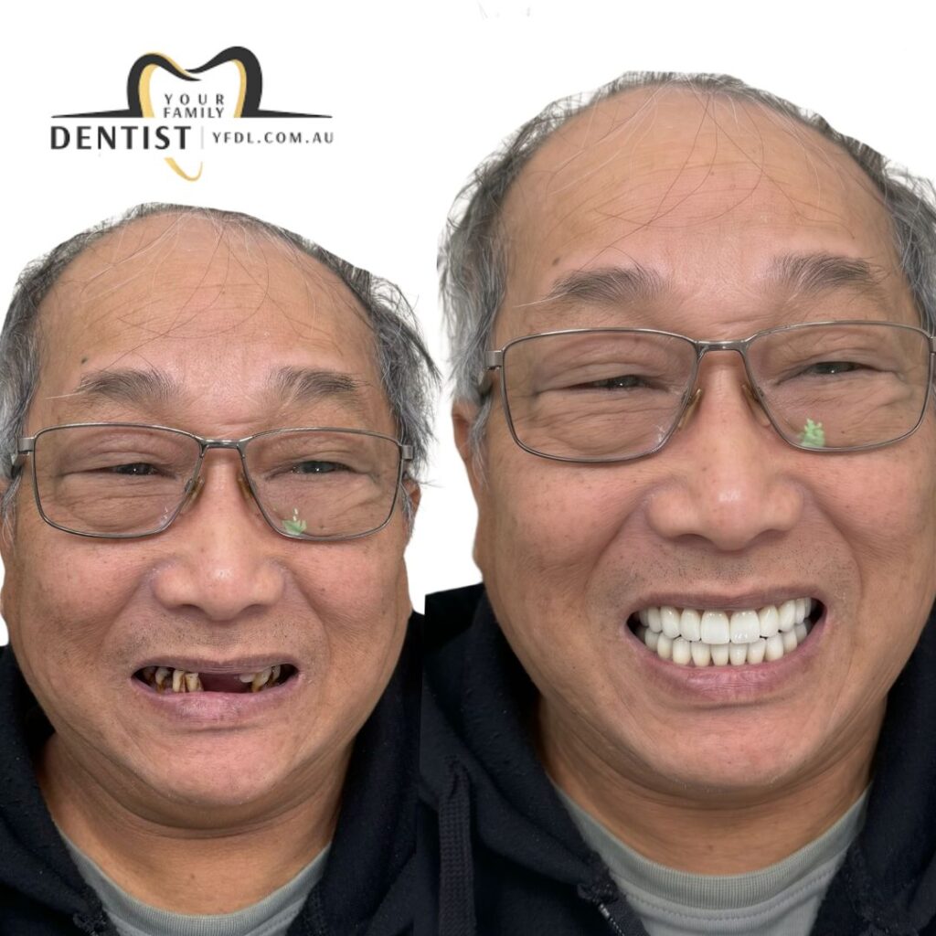 Dental implant