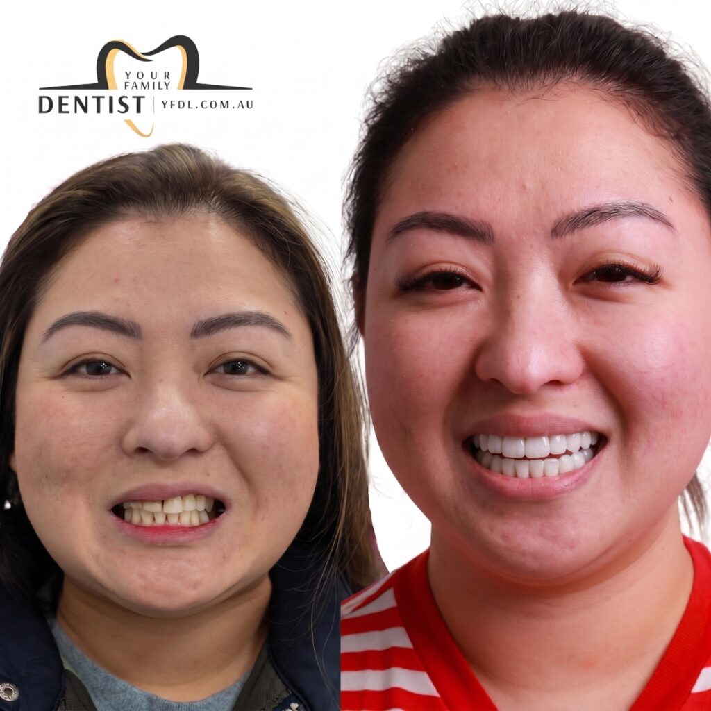 Dental Veneers