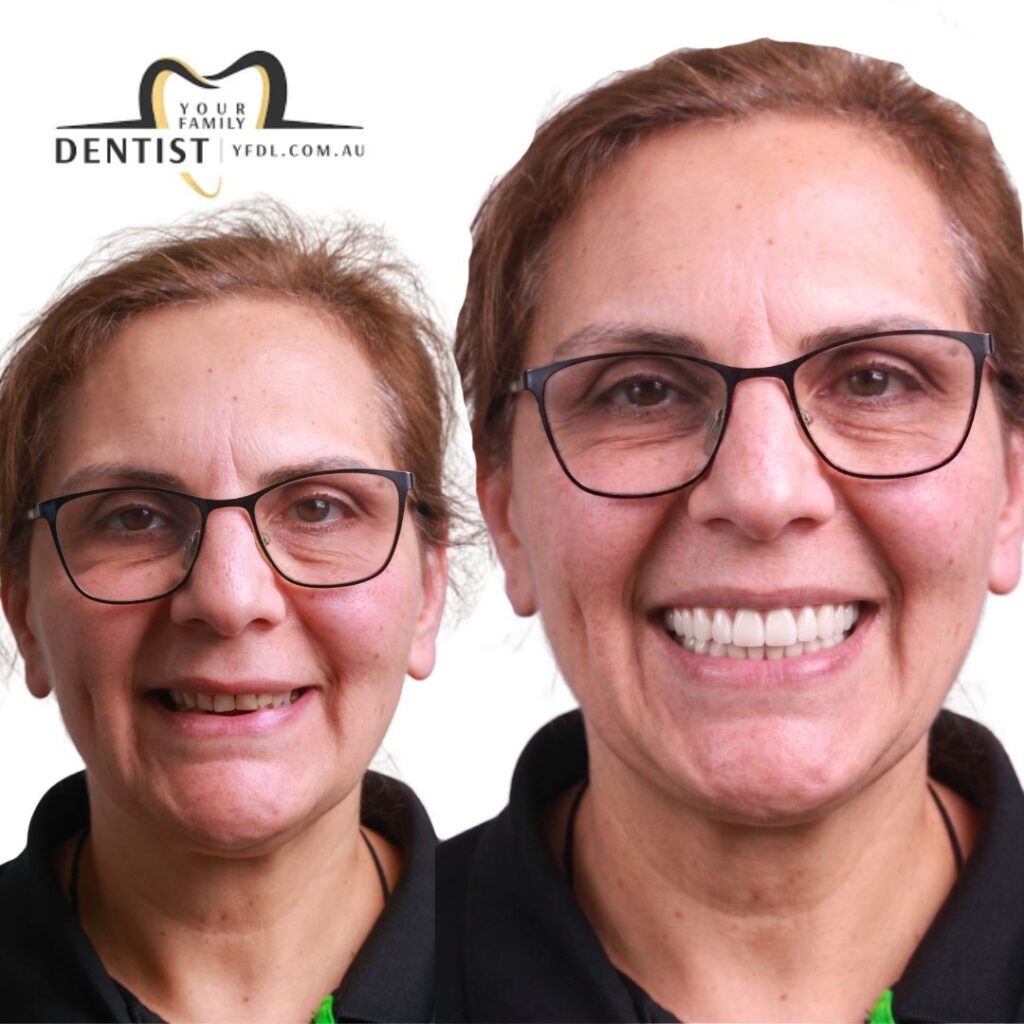 Dental Veneers