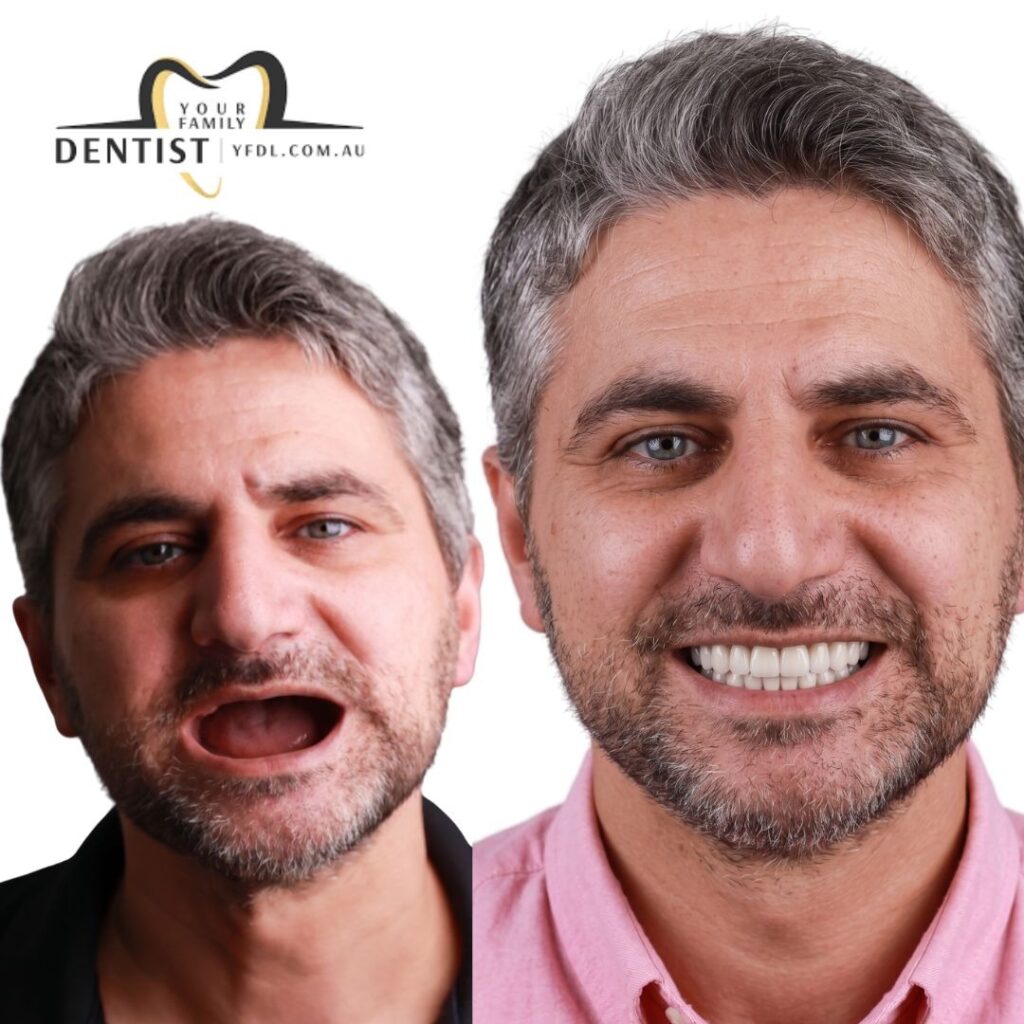 Dental implant