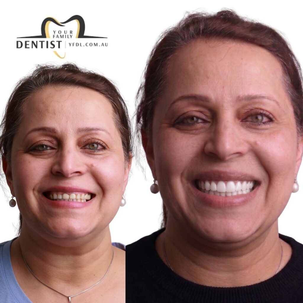 Dental Veneers