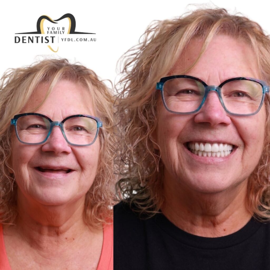 Dental Veneers