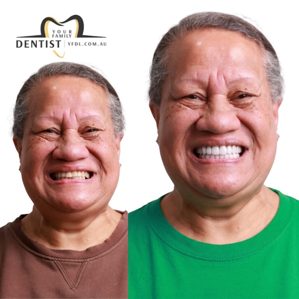 Dental Veneers