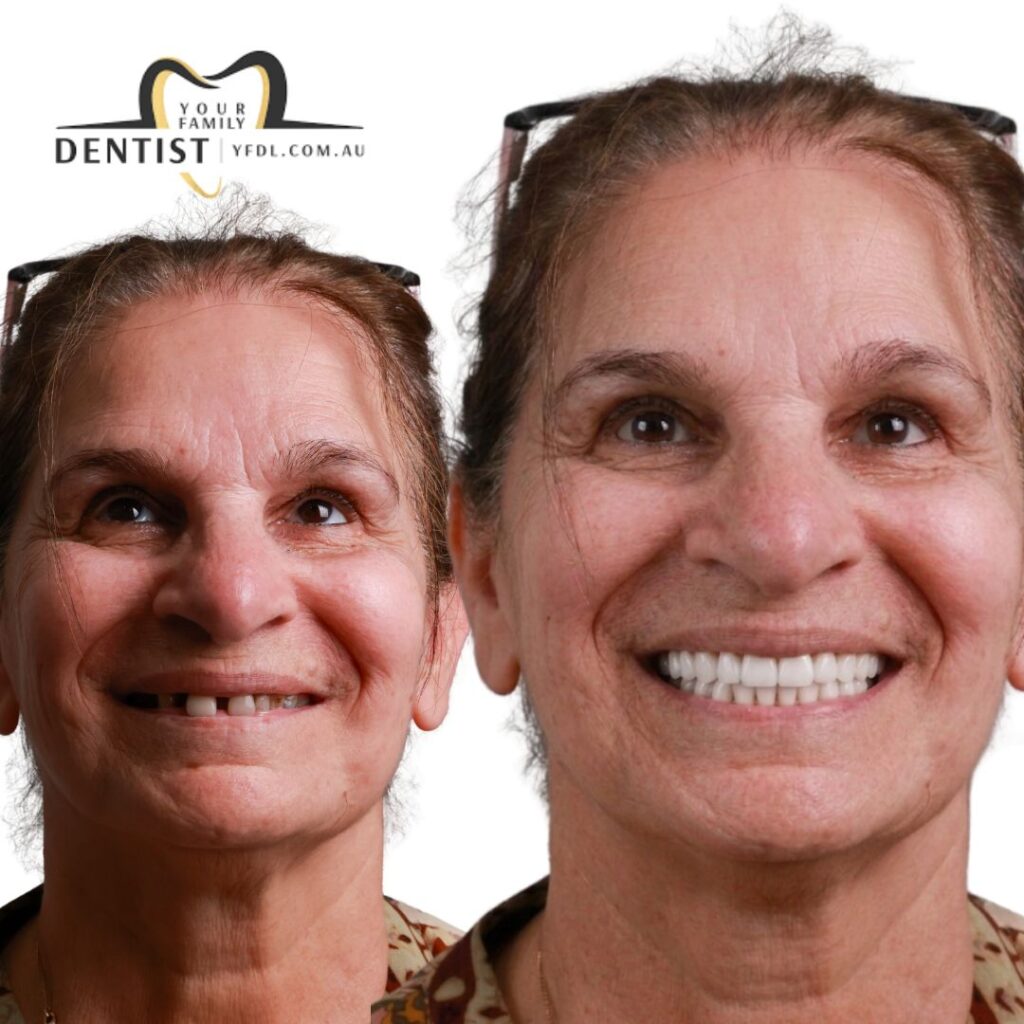 Dental Veneers