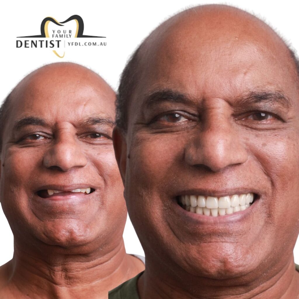 Dental Veneers