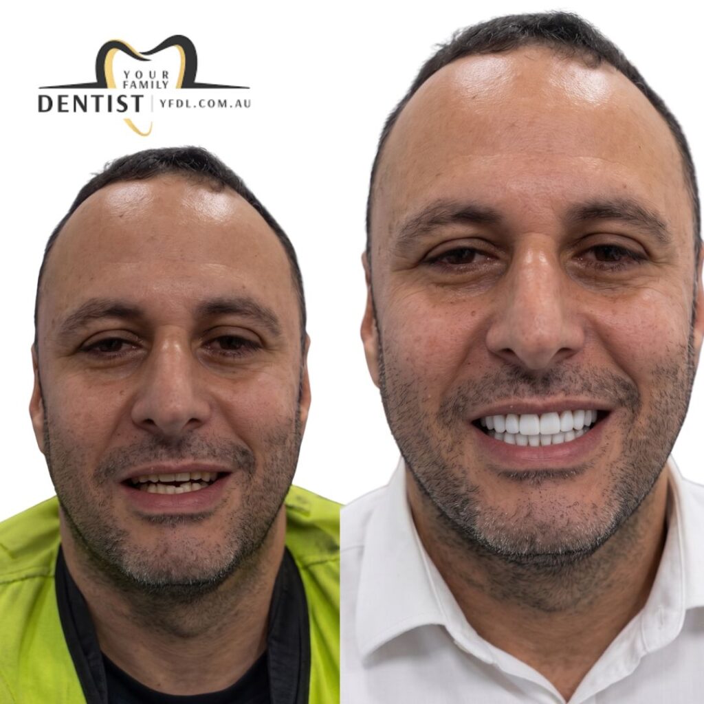 Dental Veneers