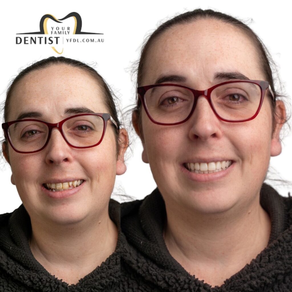 Dental Aligners
