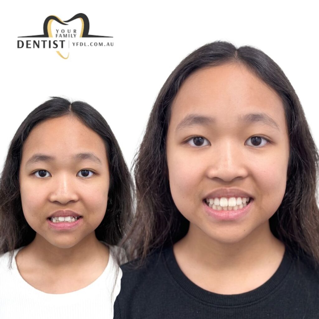 Dental Aligners