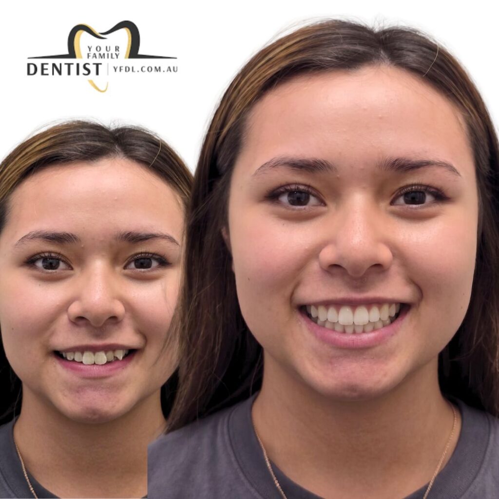Dental Aligners